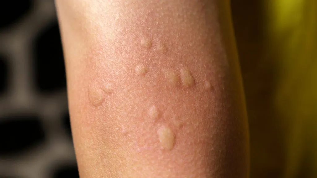 Urticaria Treatment